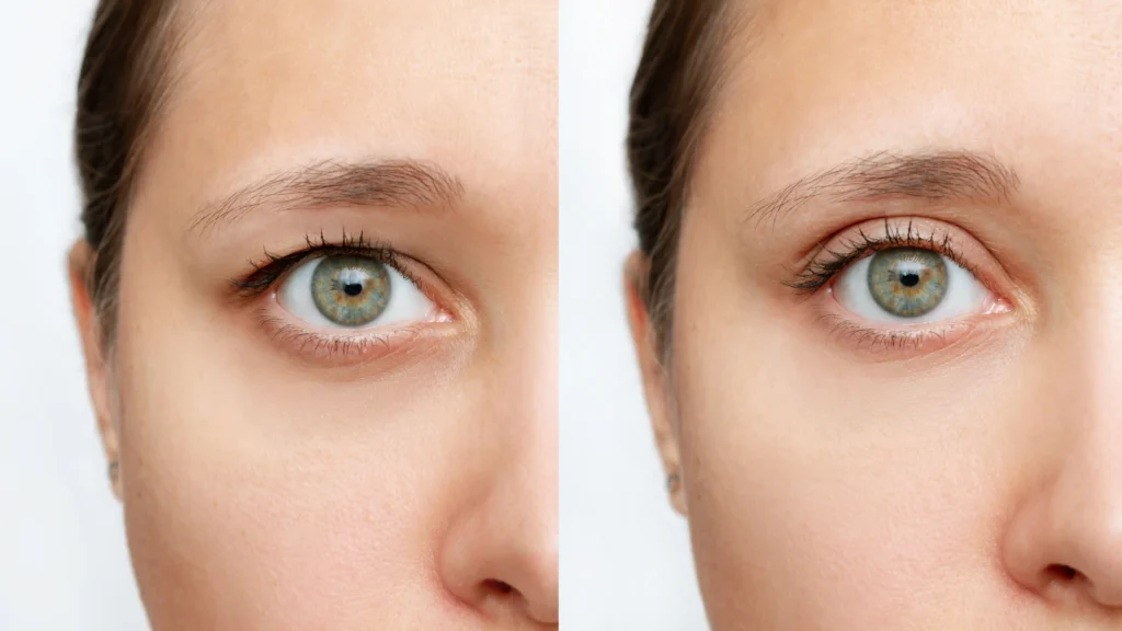 Side-by-side close-up of one eye showing differences in upper and lower eyelid appearance