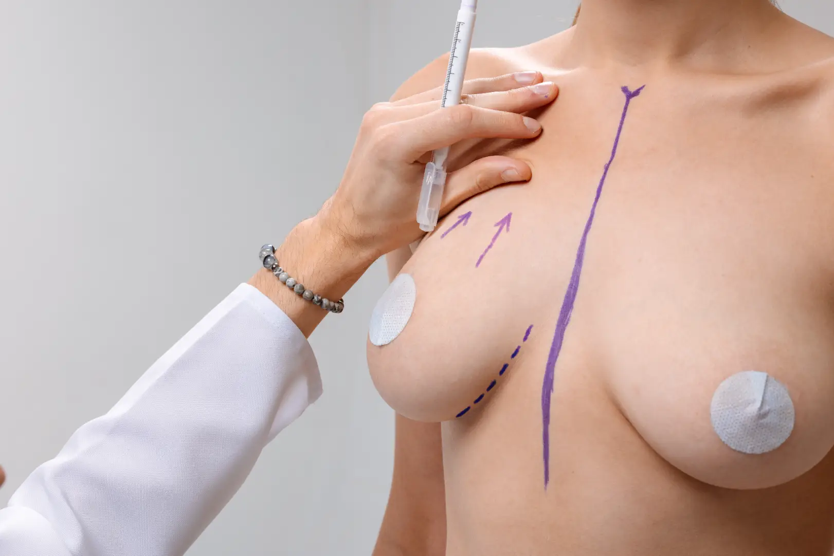 Surgeon marking the breast area with guide lines during a preoperative breast lift consultation.